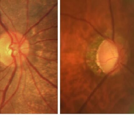 眼壓高=青光眼嗎？青光眼專科醫師幫你解惑！