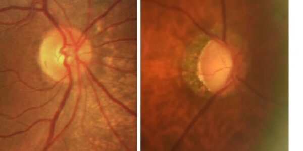 眼壓高=青光眼嗎？青光眼專科醫師幫你解惑！