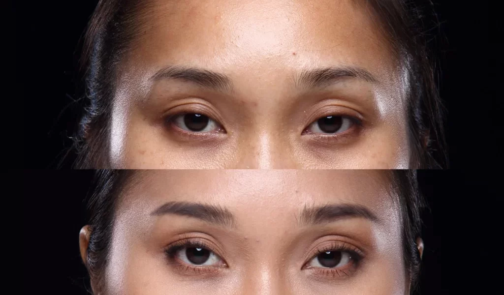 不只熬夜惹禍！醫揭黑眼圈4大元兇　遺傳與過敏也中鏢