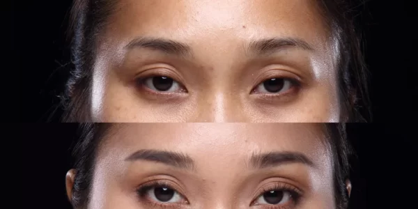 不只熬夜惹禍！醫揭黑眼圈4大元兇　遺傳與過敏也中鏢